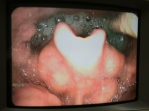 FEES assessment of swallowing