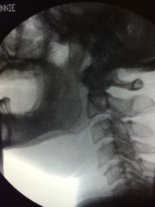 Videofluorosocopy (VFS)